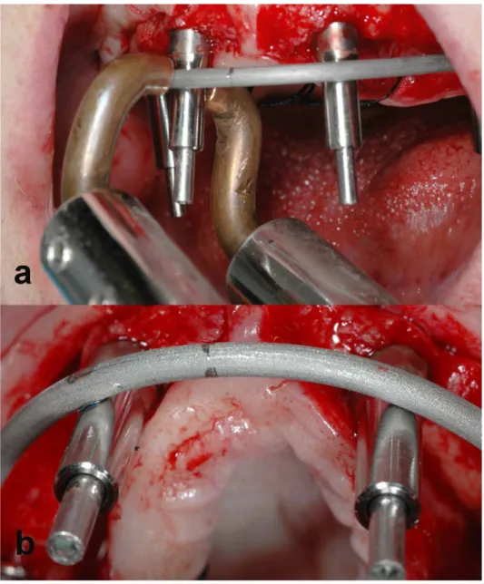 Fig.  4: The  welded superstructure is transferred outside of the oral cavity and a cast-model is  created, thanks to the incorporation of analogs of the angulated abutments  (view from above and  from one side)