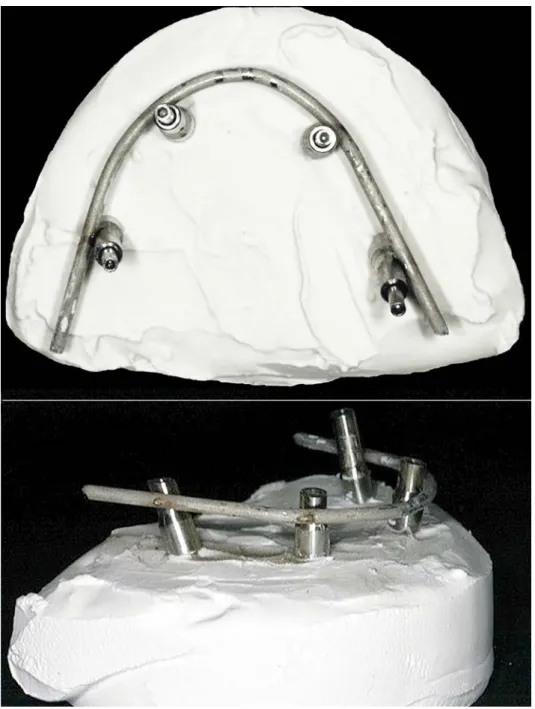 Fig.  5: The hollowed prosthesis, prepared in advanced following functional and esthetical  indications,  is used as individual impression tray