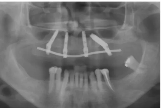 Fig.  9: Frontal view of the patient´s mouth on the day of the surgery before (a) and after (b) the  restoration