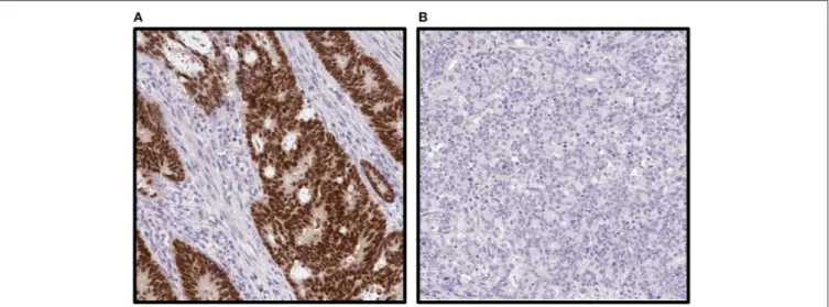 FIGURE 2 | Immunohistochemical staining images of caudal-type homeobox 2 (CDX2) on tumor tissue microarray in a population-based Scandinavian cohort of metastatic colorectal cancer patients