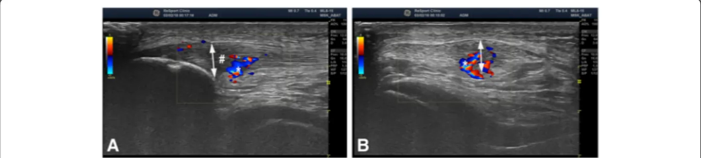 Fig. 4 US+Doppler picture (Longitudinal (a) and transversal (b) view) from a patient suffering from proximal patellar tendinopathy-Jumper ’s knee, showing a thickened patellar tendon (doble head-arrow) with structural changes and hypo-echoic regions (#) to