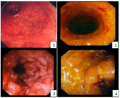 Figure 1: Grades of inflammation detected in Ulcerative colitis via endoscopy.   