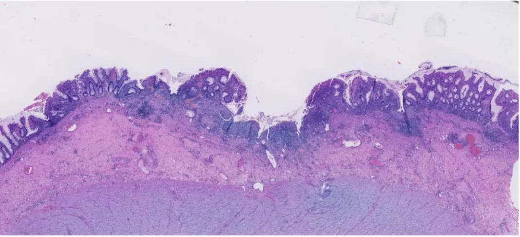 Figure 2: Microscopic picture of ulcerative colitis. Photo taken by Marina Perdiki Grigoriadi