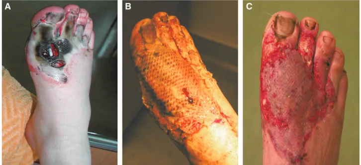 Fig. 3.  a, Shows a friction injury in a 22-year-old male patient before operation. B, Shows 4 days after operation with a distally based eDB  muscle flap covering a 5 × 5 cm defect and additional skin graft on the adjacent wound