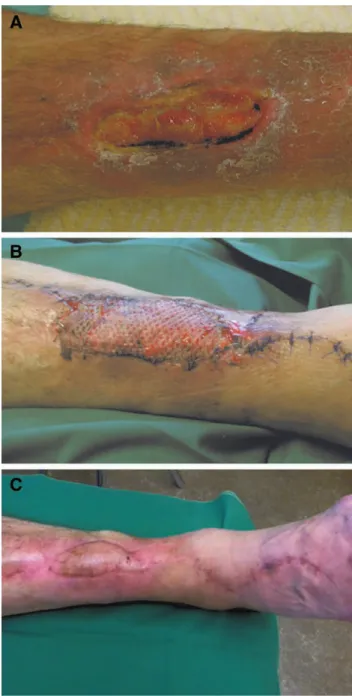 Fig. 5. a, Shows an exposed tibial plate in a 4 × 5 cm defect in a  65-year-old female patient before operation