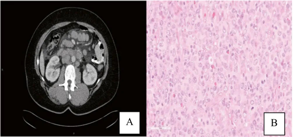Figure 9. Computed tomography of the abdomen show para aortal lymphadenopathy  (A).  Histomorphology with HE staining showing involvement of DLBCL (B)