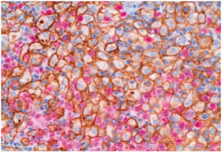 Figure 11. Immunohistochemical double staining with PD-L1 (brwon) and PAX5  (red) in a tumor biopsy from a patient with PCNSL