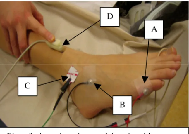 Figur 4 visar placering av elektroder vid motorisk neurografi på n. tibialis.