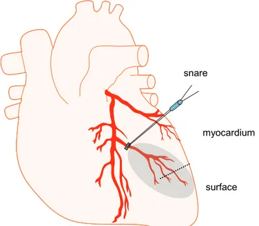 Figure 7. Schematic picture over the heart, placement of the snare over the LAD branch and the MD  probe in the myocardium (dotted line) and on the surface of the heart (solid line)