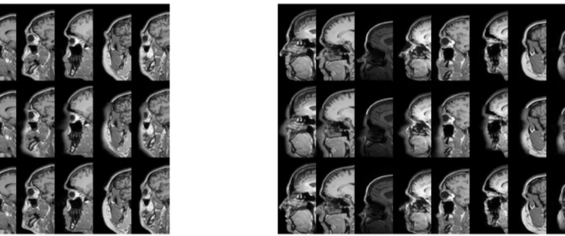 Fig. 1. Typical results of refacing face-blurred images. Left: results for training using only subjects from Guy’s hospital, Right: results for training using data from all 3 sites