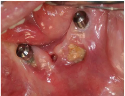 Figure 3.  Exposed alveolar bone in the mandible of a  patient with intravenous bisphosphonate therapy