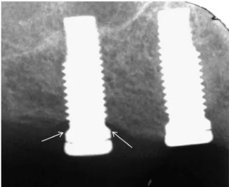 Figure  9.  Dental  radiograph  (patient  16)  showing  a  bisphosphonate  coated  implant  (right)  and  a  control  (left)