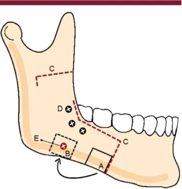 Fig 1. Schematic photo of surgical and anatomical structures. (A) Bone graft donor site at the inferior border of lateral segment of mandible split.