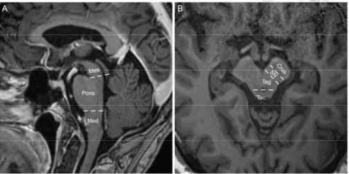 Figure 3. Definition of brainstem and mesencephalic structures. The mesencephalon  was anatomically divided into the three regions; (1) crus cerebri, (2) substantia nigra  and tegmentum, and (3) tectum including the superior and inferior colliculi, Mes =  