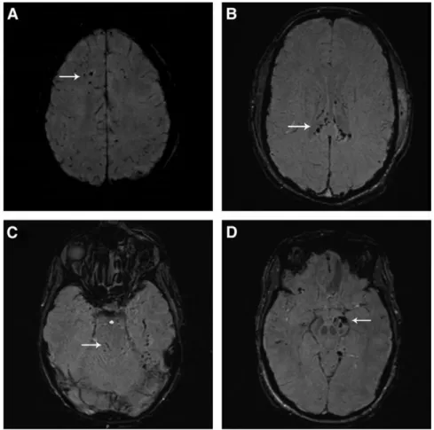 FIG. 2. (A) Diffuse axonal injury (DAI) stage I: susceptibility-weighted imaging (SWI) of a 19-year-old male involved in a motor vehicle accident