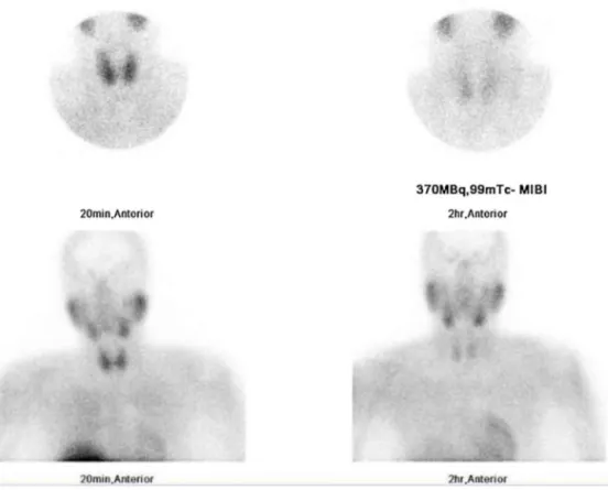 Fig. 2. Early and late 99mTc-sestamibi scintigraphy parathyroid scan images of neck and mediastinum anteriorly at 20 min and 2 h showing increased focal uptake suggestive of right inferior parathyroid adenoma.