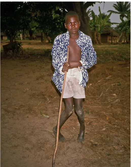 Figur 4. Den första person med konzo som vi mötte i Zaire. Det var på hösten 1986 inte långt  från Vangasjukhuset centralt i Bandunduprovinsen