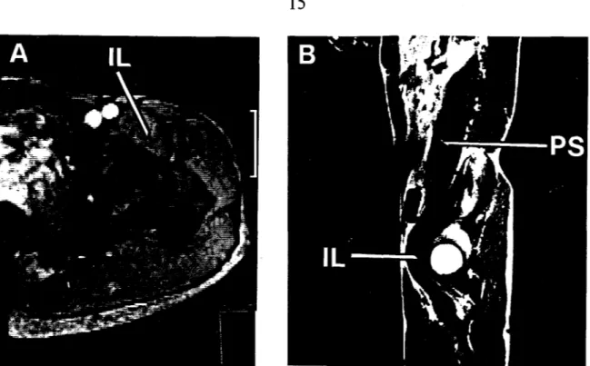Figure  1.  MRI  sections  showing  where  the  intra-muscular  wire  electrodes  were· 