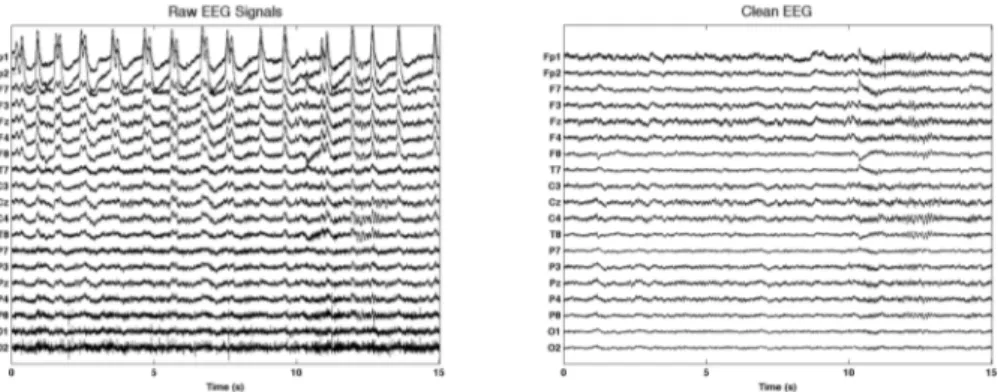 Figure 2. a) EEG signal with artifacts during eye blink task b) EEG signal after artifacts handling 