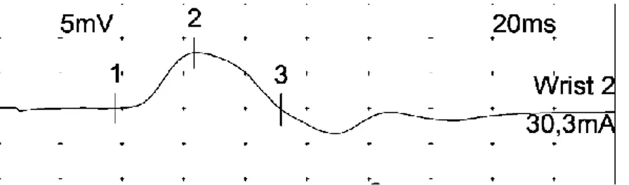 Figur 1: Bilden visualiserar en motorisk mätning i medianusnerven. I bilden  visar  sifforna  1:  Latens,  2:  amplitud,  avstånd  mellan  1–3  är  duration