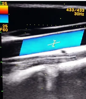 Fig. 2. Ultrasound picture showing the CCA with color Doppler and cursor angle of 60°