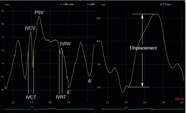 Figure 4.  Typical  tissue  velocity  echocardiographically  derived  velocity  and  displacement  profiles  from  the  basal  lateral  wall  during  one  cardiac  cycle.  IVCT  =  isovolumic  contraction  time,  IVCV  =  isovolumic  contraction  velocity,