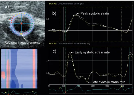 Figure 9.  a) ROI corresponding to the cross‐sectional area of the CCA short‐axis image. The  large, yellow dot in the far wall corresponds to the position of the regional measurements. b‐c)  Typical  circumferential  strain  and  strain  rate  curves  fro