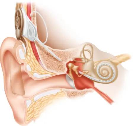Figure 1: The cochlea after a CI has been implanted. Illustration provided by  Staffan Larsson
