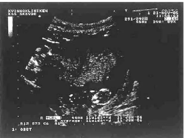 Fig. 3. Fetus CRL 44 mm gestational age 11 weeks 1 day.