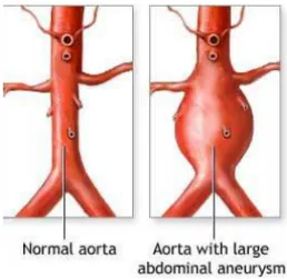 Figure 4. A normal AA and an AAA (Illustration-2). 