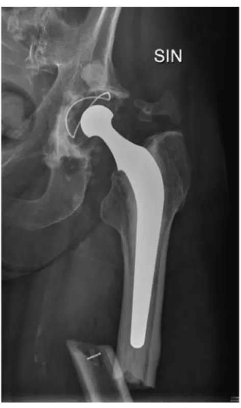 Figure  2.  Periprosthetic  atypical  femoral fractures  under  the  cement  mantle.  The lateral cortex is thickened and the fracture line is short oblique