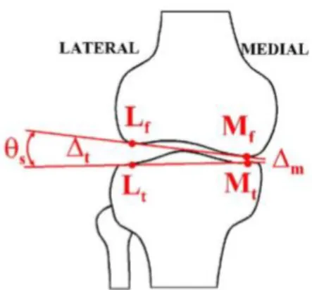 Figure 1 show the anatomy and decreased  angle of a knee with OA on the medial side   (Dennis, Komistek, Nadaud, &amp; Mahfouz, 2006).