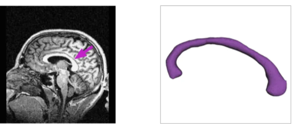 Figure 5.1.3: Left: a sample image from the OASIS data set. The arrow points out the corpus callosum region