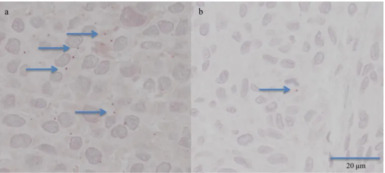 Fig 1. Immunohistochemistry with positive staining for pp65 in the form of small distinct granular structures, either in the nucleus or cytoplasm