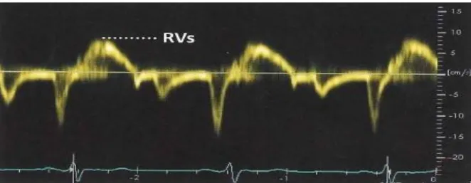 Figur 4 visar annulus tricuspidalis maximala systoliska hastighet (RVs´) mätt med Tissue Doppler  Imaging (TDI) (5)