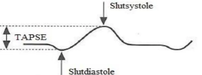 Figur 2. Illustrering av hur Tricuspid Annular Plane Systolic Excursion mäts i M-mode kurvan