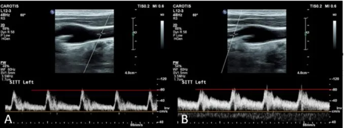 Figur 3. Mätning av flödeshastighet med pulsad doppler i arteria carotis communis (A) och arteria  carotis interna (B)