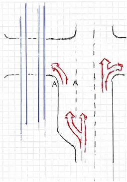 Figur 6  Korsning med ficka för vänstersvängande trafik. Eventuellt ljussignaler vid A  och A
