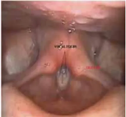 Figure 4: Laryngoscopic pictures of normal opening and closing phases of the glottis  are shown in figure 4a and 4b respectively