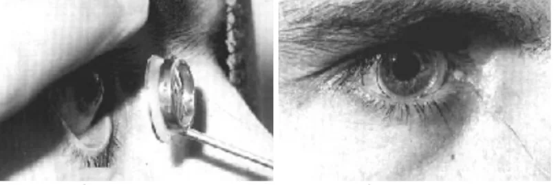 Figure 7. Scleral Search Coils on. 