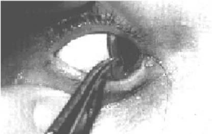 Figure 8. Scleral Search Coils off. 