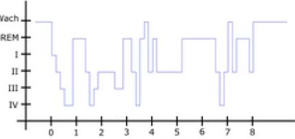 Figure 1: representation of the sleep macrostructure (states I, II, III and IV and REM)