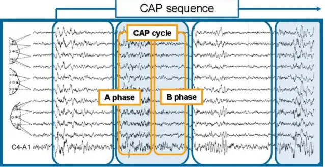 Figure 2: an example of cyclic alternating pattern (CAP) in sleep stage 2 [12-13]. 