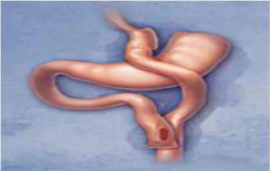 Figur 1: Gastric Bypass 