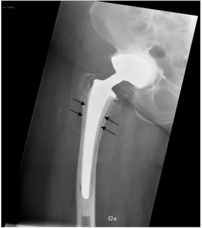 Figur 3. Slätröntgenbild av en högersidig höftprotes uppvisande radiologiska tecken till lossning med  uppklarningszoner mellan protes och cement (Pat Nr 5) 