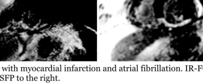 Figure 5. Patient with myocardial infarction and atrial fibrillation. IR-FGRE sequence to  the left and SS-SSFP to the right