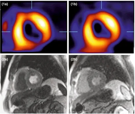 Figure 1 SPECT (1a and 1b) and CMR GRE- GRE-EPI (2a and 2b) images of reversible  myocar-dial ischaemia