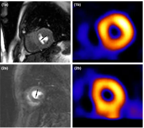 Figure 3 Dark rim artefact at arrows on CMR perfusion images using SSFP (1a) and GRE-EPI (2a) sequences