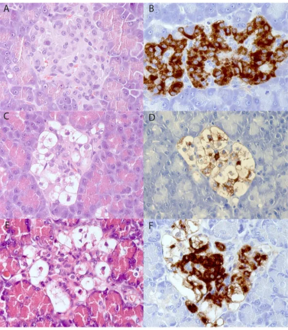 Figure 1. Pancreatic specimens stained with hematoxylin-eosin (A, C, E) and immunostained for insulin (B, D, F)