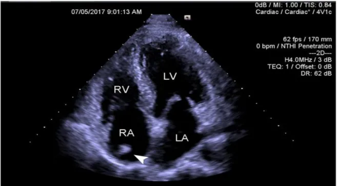 Figur  2:  Hjärtat  i  en  fyrkammarvy  tagen  via  transthorakal  ekokardiografi.  RV  =  höger  kammare, LV = vänster kammare, RA = höger förmak, LA = vänster förmak